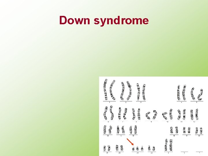 Down syndrome 