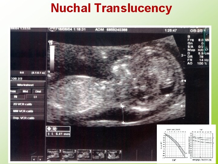 Nuchal Translucency 