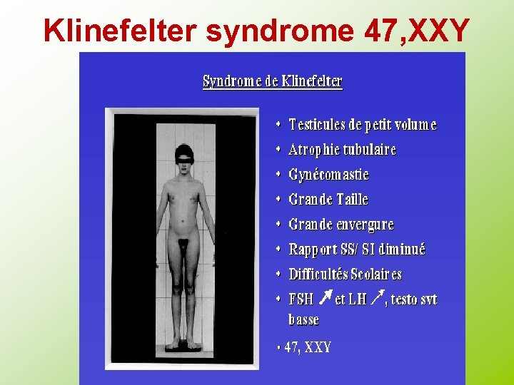 Klinefelter syndrome 47, XXY 