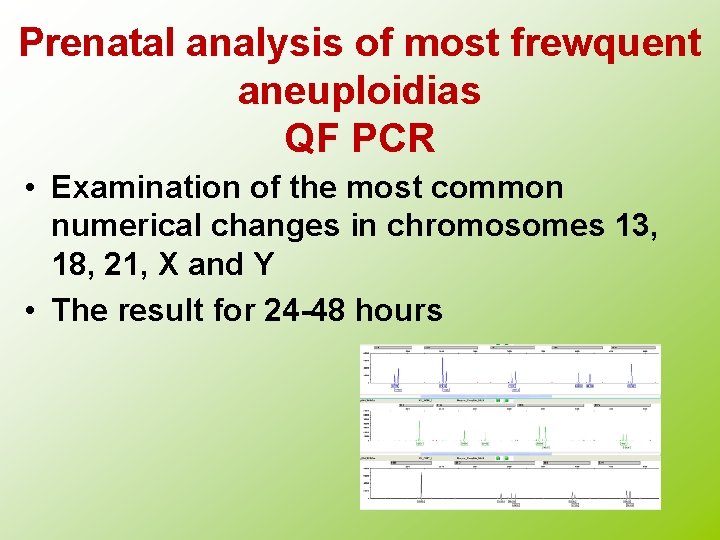 Prenatal analysis of most frewquent aneuploidias QF PCR • Examination of the most common