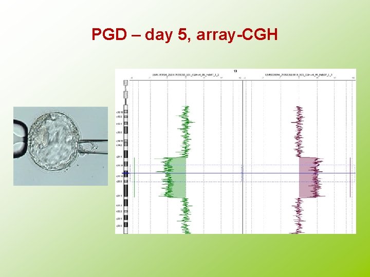 PGD – day 5, array-CGH 