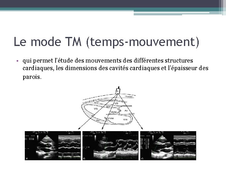 Le mode TM (temps-mouvement) • qui permet l’étude des mouvements des différentes structures cardiaques,