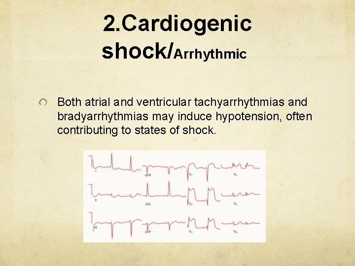 2. Cardiogenic shock/Arrhythmic Both atrial and ventricular tachyarrhythmias and bradyarrhythmias may induce hypotension, often