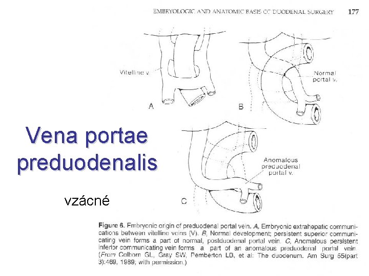 Vena portae preduodenalis vzácné 