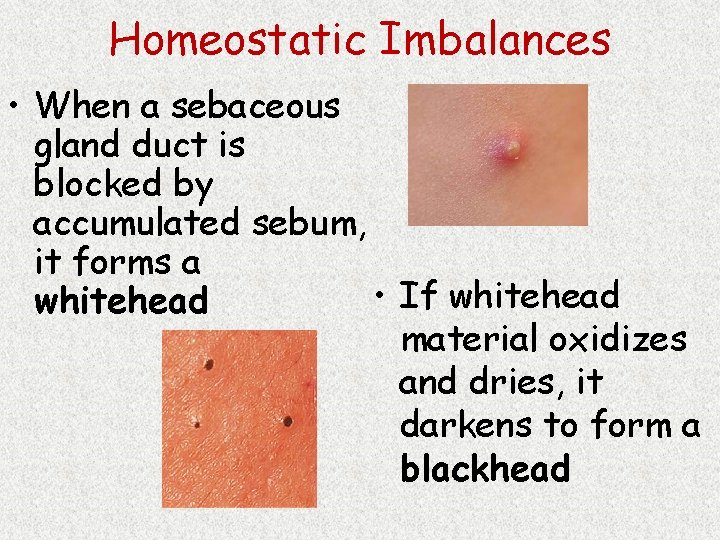 Homeostatic Imbalances • When a sebaceous gland duct is blocked by accumulated sebum, it