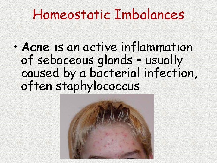 Homeostatic Imbalances • Acne is an active inflammation of sebaceous glands – usually caused
