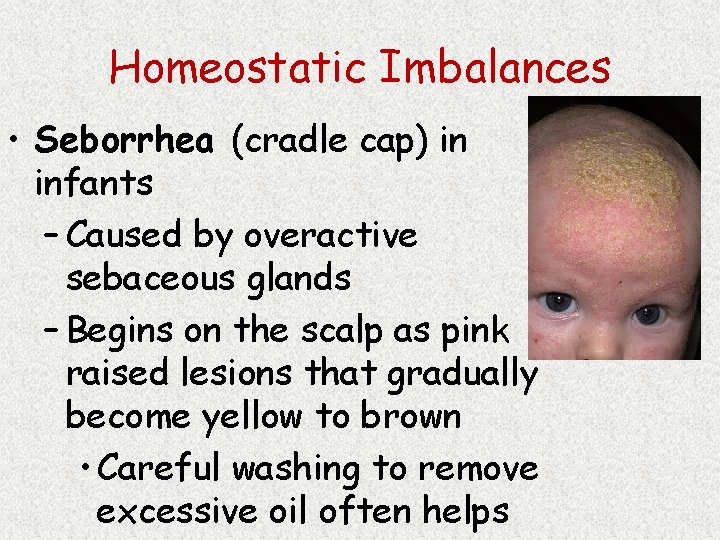 Homeostatic Imbalances • Seborrhea (cradle cap) in infants – Caused by overactive sebaceous glands