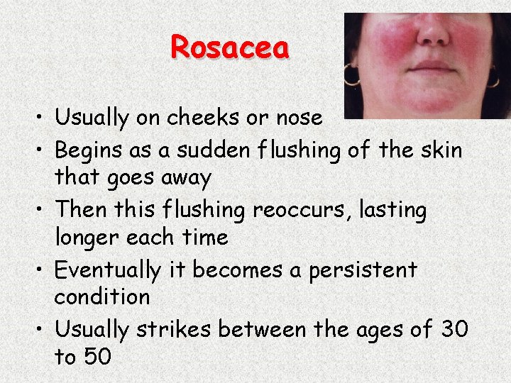 Rosacea • Usually on cheeks or nose • Begins as a sudden flushing of
