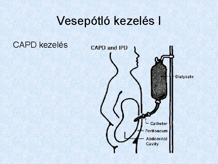Vesepótló kezelés I CAPD kezelés 