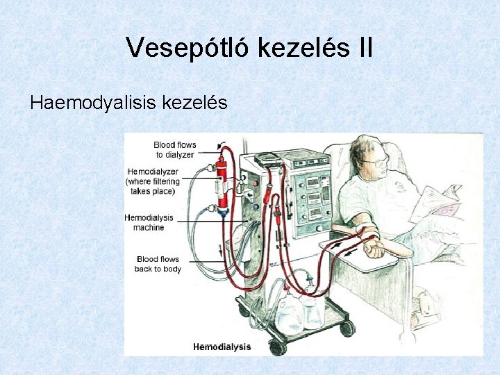 Vesepótló kezelés II Haemodyalisis kezelés 