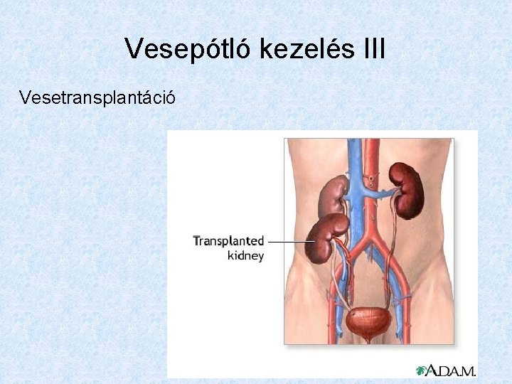 Vesepótló kezelés III Vesetransplantáció 