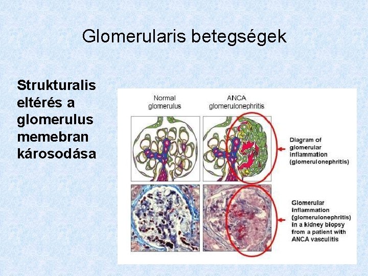 Glomerularis betegségek Strukturalis eltérés a glomerulus memebran károsodása 