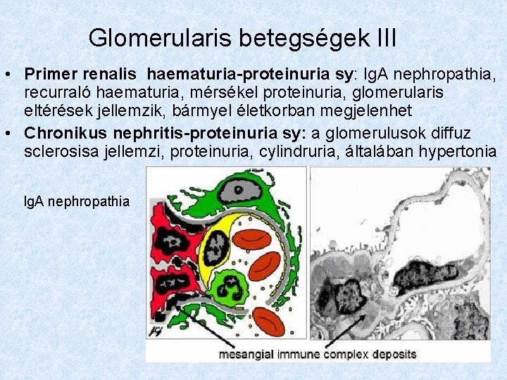 Glomerularis betegségek III • Primer renalis haematuria-proteinuria sy: Ig. A nephropathia, recurraló haematuria, mérsékel