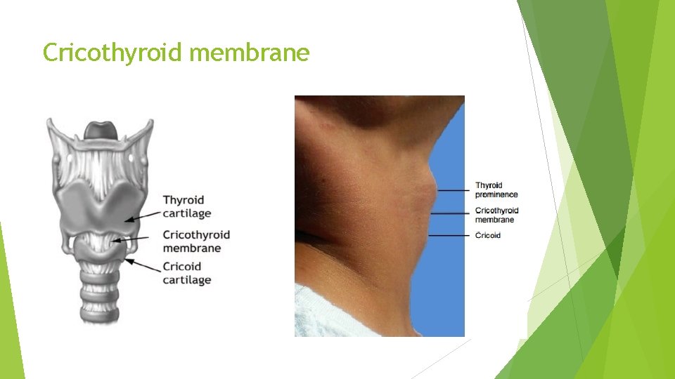 Cricothyroid membrane 