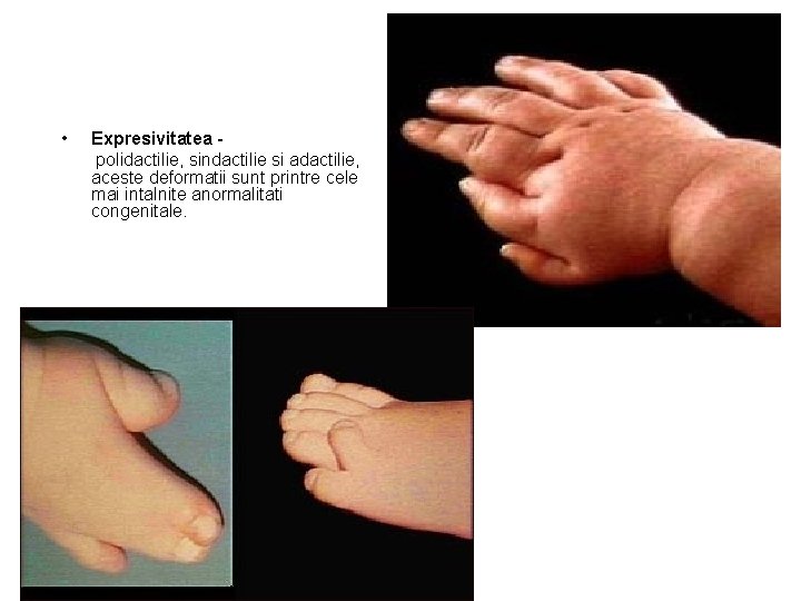  • Expresivitatea polidactilie, sindactilie si adactilie, aceste deformatii sunt printre cele mai intalnite