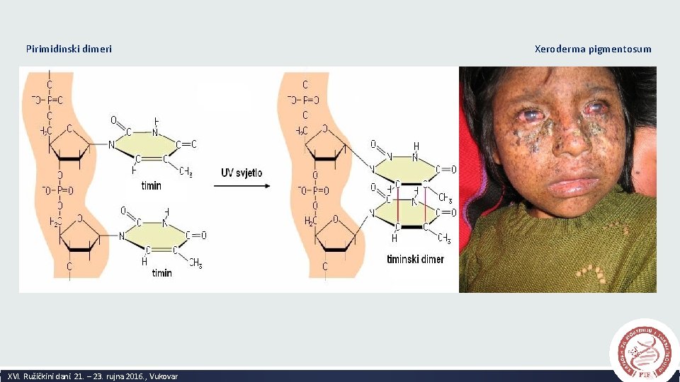 Pirimidinski dimeri XVI. Ružičkini dani. 21. – 23. rujna 2016. , Vukovar Xeroderma pigmentosum
