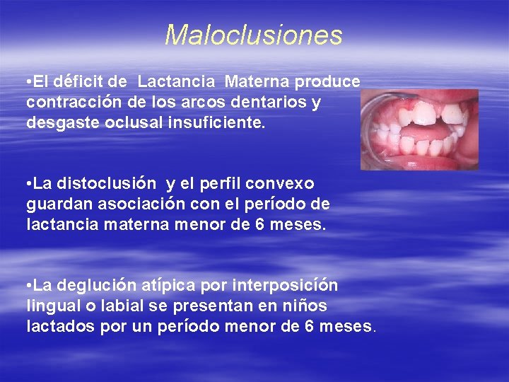 Maloclusiones • El déficit de Lactancia Materna produce contracción de los arcos dentarios y