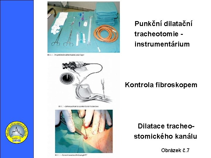  Punkční dilatační tracheotomie instrumentárium • Kontrola fibroskopem • Dilatace tracheo • stomického kanálu
