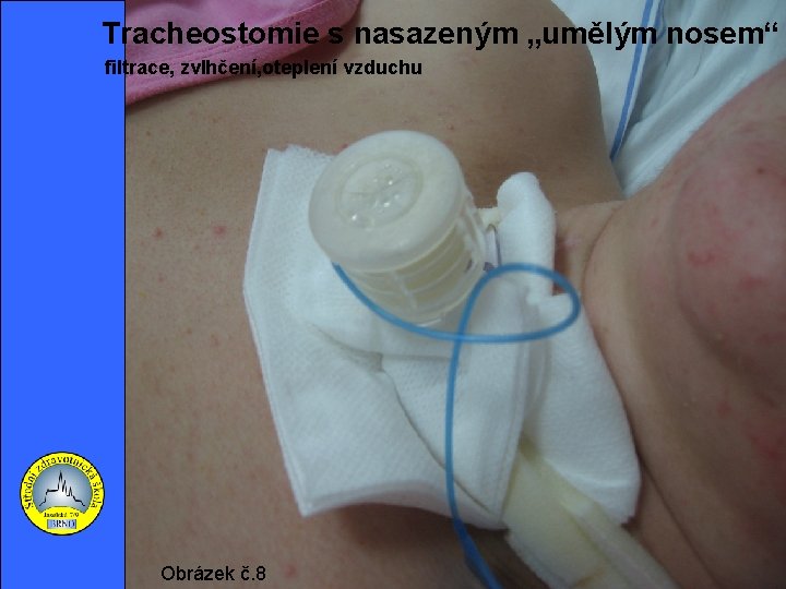  Tracheostomie s nasazeným „umělým nosem“ filtrace, zvlhčení, oteplení vzduchu Obrázek č. 8 