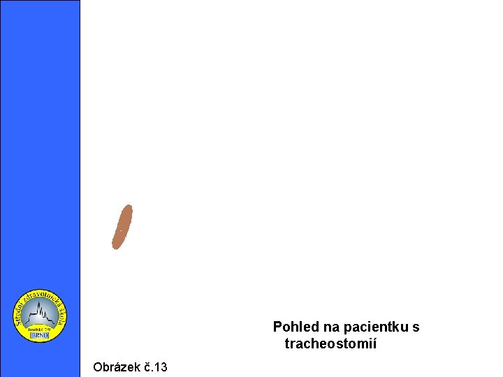 Pohled na pacientku s tracheostomií Obrázek č. 13 