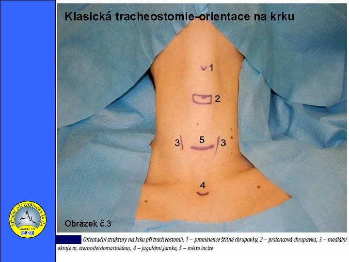 Klasická tracheostomie-orientace na krku http: //img. mf. cz/789/935/31. jpg Obrázek č. 3 