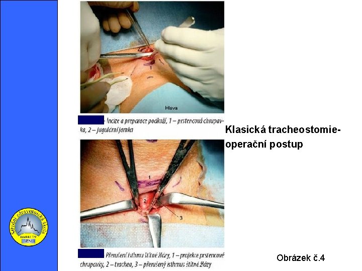 Klasická tracheostomieoperační postup Obrázek č. 4 
