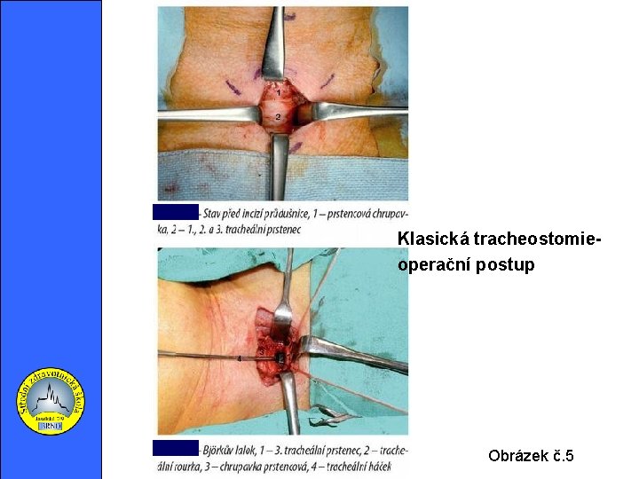 Klasická tracheostomieoperační postup Obrázek č. 5 