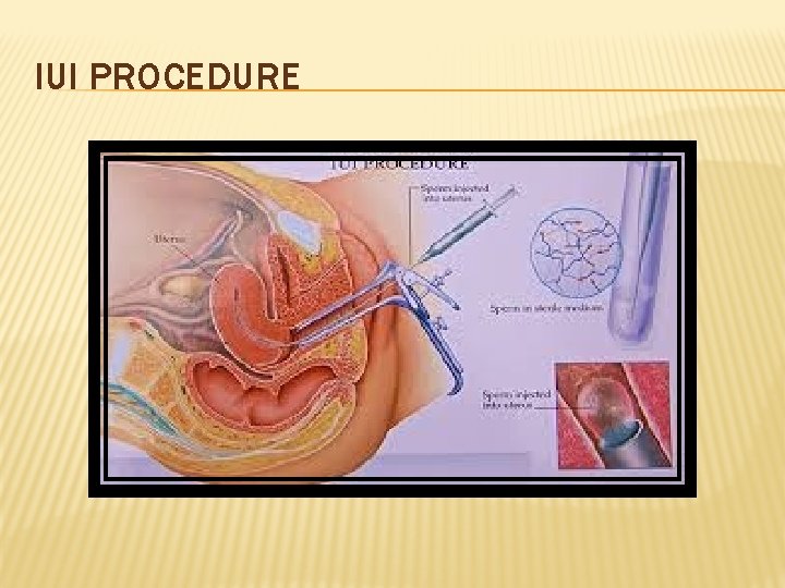 IUI PROCEDURE 