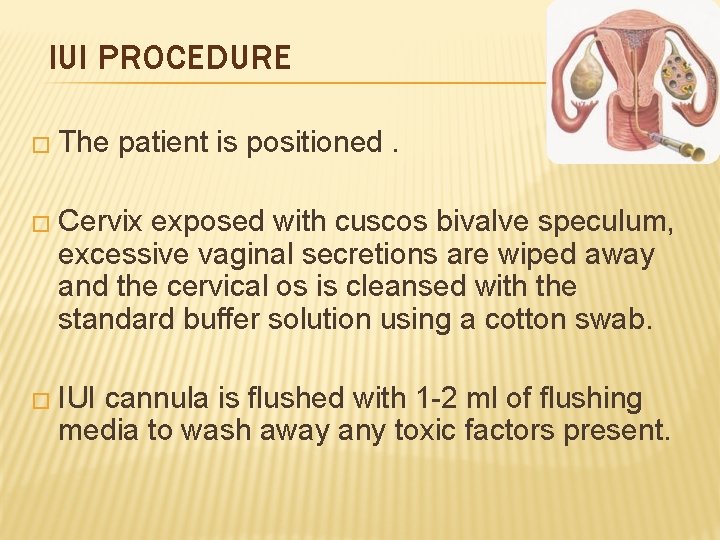 IUI PROCEDURE � The patient is positioned. � Cervix exposed with cuscos bivalve speculum,