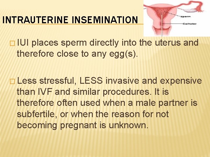 INTRAUTERINE INSEMINATION � IUI places sperm directly into the uterus and therefore close to