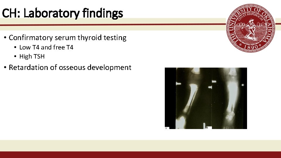 CH: Laboratory findings • Confirmatory serum thyroid testing • Low T 4 and free