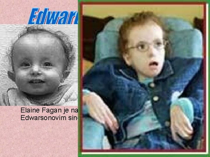 Edwardov sindrom ali trisomija 18, bolezen je bila prvič opisana leta 1960. (Edwardsa) Pogostost