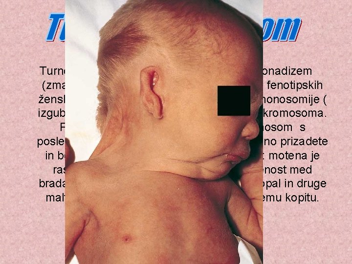 Turnerjev sindrom označuje primarni hipogonadizem (zmanjšano izločanje spolnih hormonov ) v fenotipskih ženskah, ki