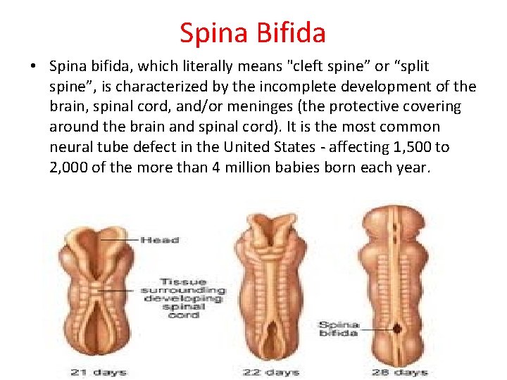 Spina Bifida • Spina bifida, which literally means "cleft spine” or “split spine”, is