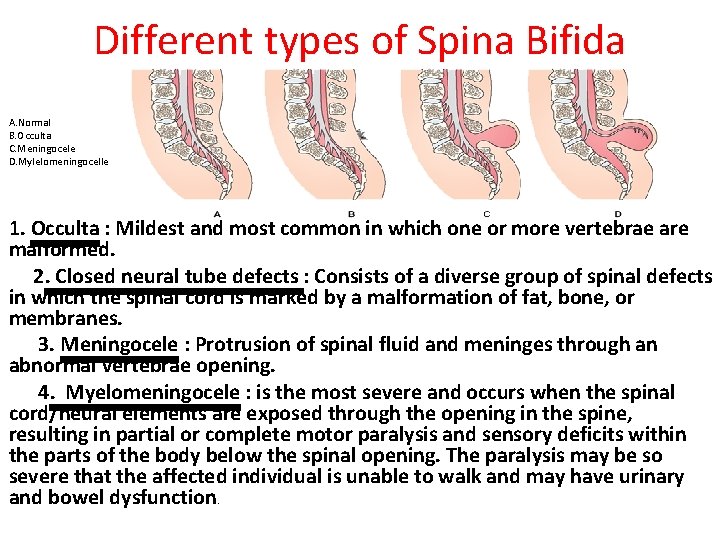 Different types of Spina Bifida A. Normal B. Occulta C. Meningocele D. Mylelomeningocelle 1.