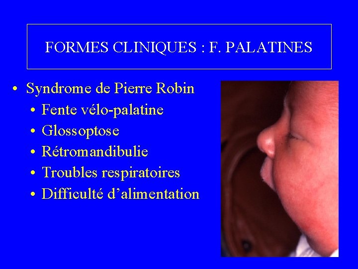 FORMES CLINIQUES : F. PALATINES • Syndrome de Pierre Robin • Fente vélo-palatine •