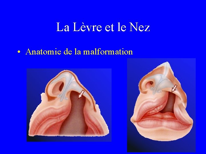 La Lèvre et le Nez • Anatomie de la malformation 