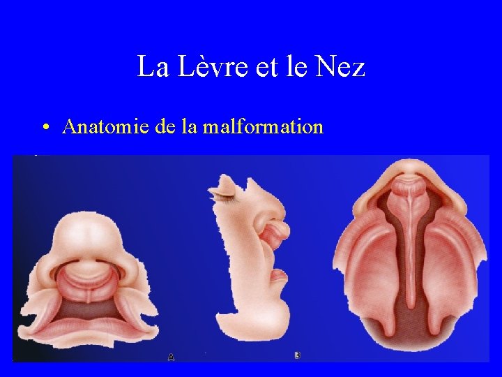 La Lèvre et le Nez • Anatomie de la malformation 