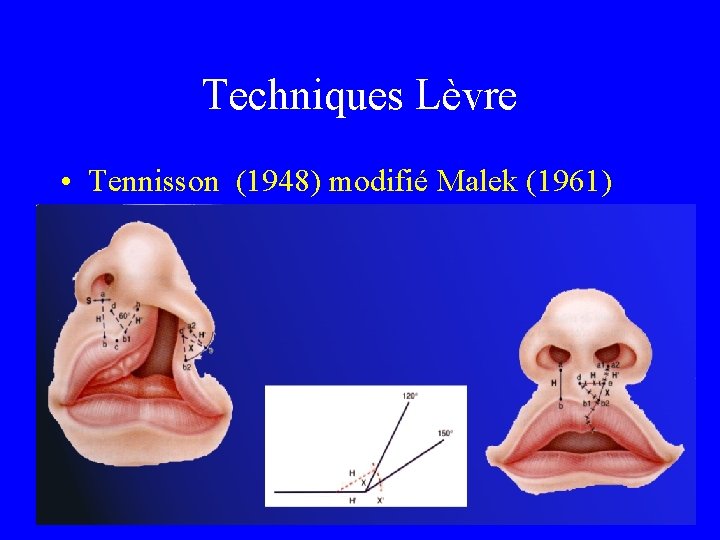 Techniques Lèvre • Tennisson (1948) modifié Malek (1961) 