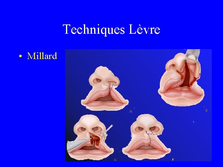 Techniques Lèvre • Millard 