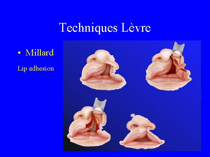 Techniques Lèvre • Millard Lip adhesion 