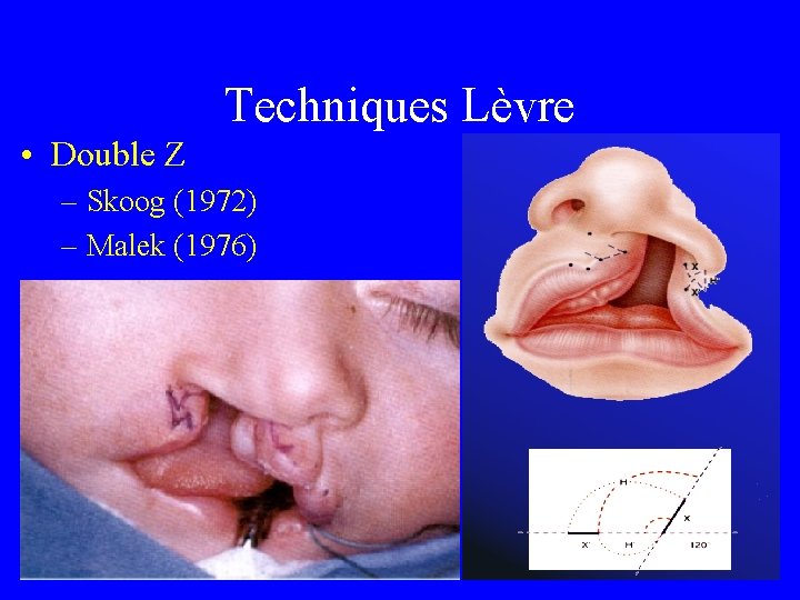 Techniques Lèvre • Double Z – Skoog (1972) – Malek (1976) 