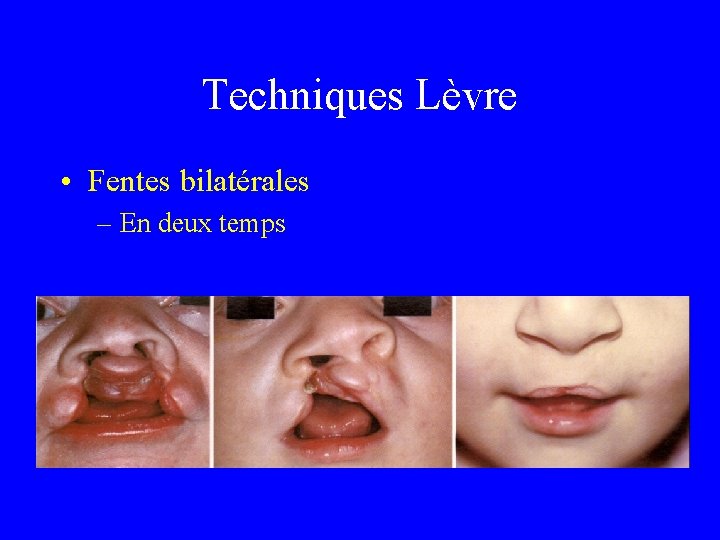 Techniques Lèvre • Fentes bilatérales – En deux temps 