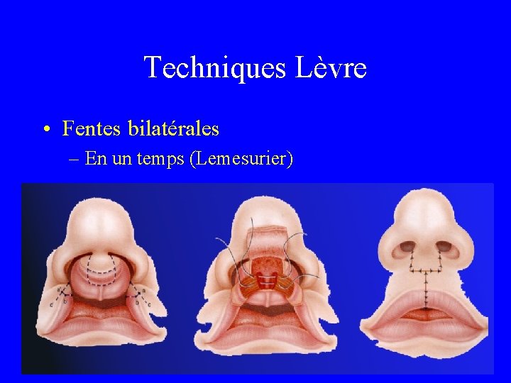 Techniques Lèvre • Fentes bilatérales – En un temps (Lemesurier) 