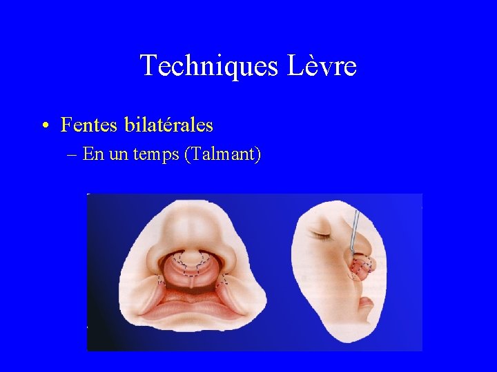 Techniques Lèvre • Fentes bilatérales – En un temps (Talmant) 