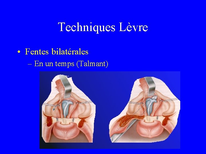 Techniques Lèvre • Fentes bilatérales – En un temps (Talmant) 