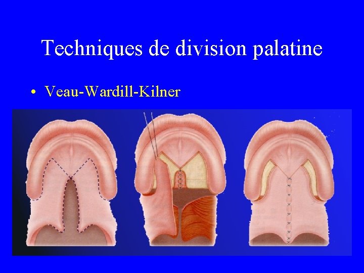 Techniques de division palatine • Veau-Wardill-Kilner 
