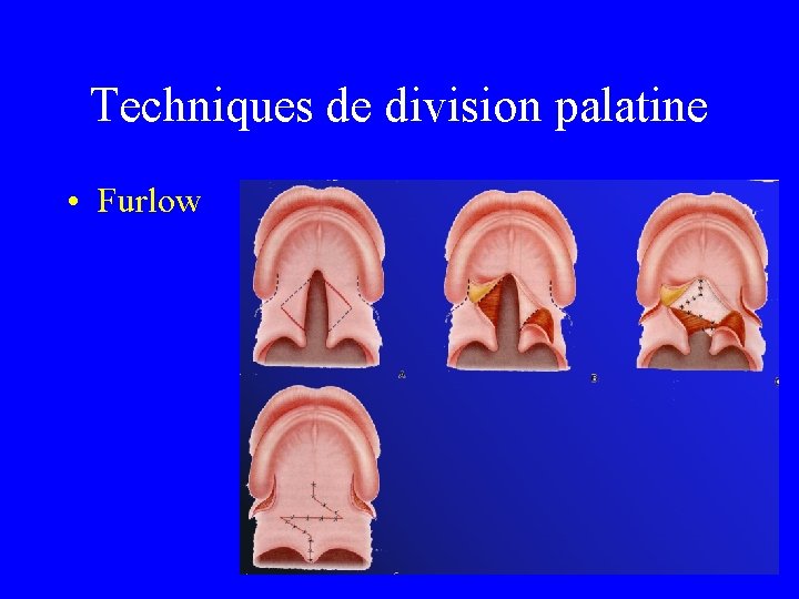 Techniques de division palatine • Furlow 