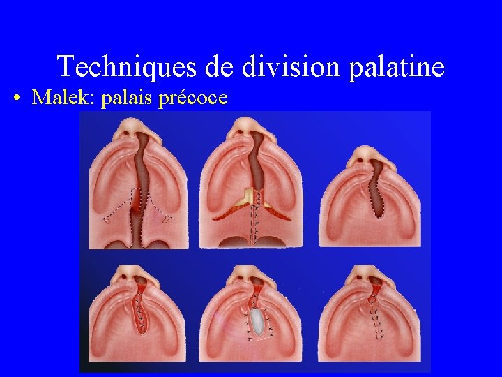 Techniques de division palatine • Malek: palais précoce 