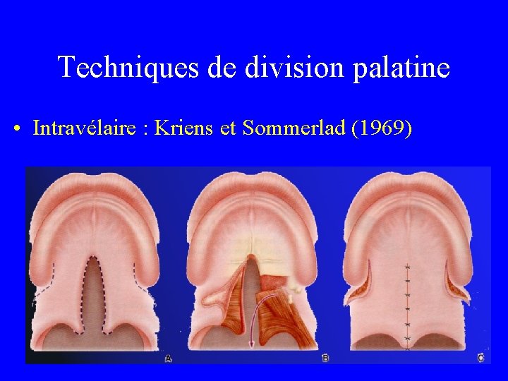 Techniques de division palatine • Intravélaire : Kriens et Sommerlad (1969) 